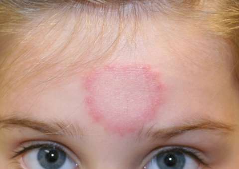 Conheça planta que combate impingem e feridas causadas por inseto 