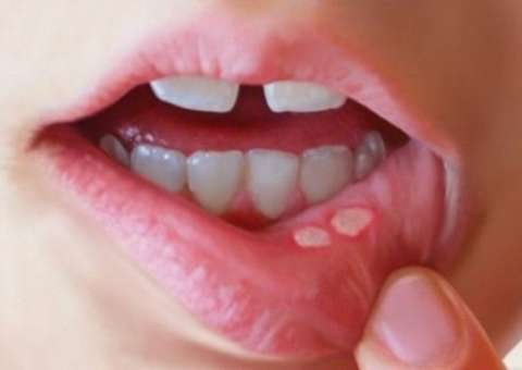 Com raiz e folhas medicinais, planta é indicada para tratar afta 