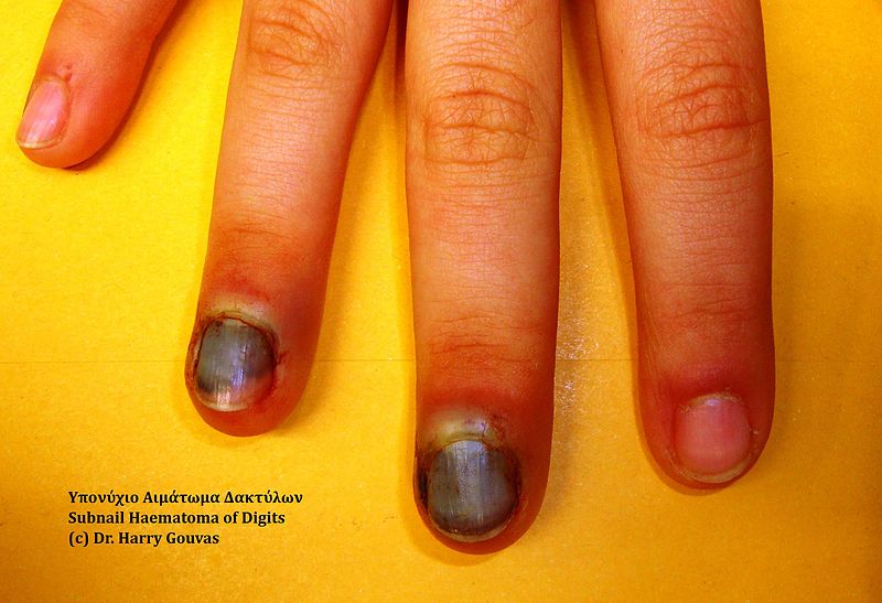 Unhas pretas? Saiba a causa e quando ir ao médico