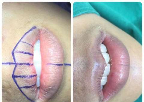 Redução de lábios é a nova tendência em cirurgia plástica