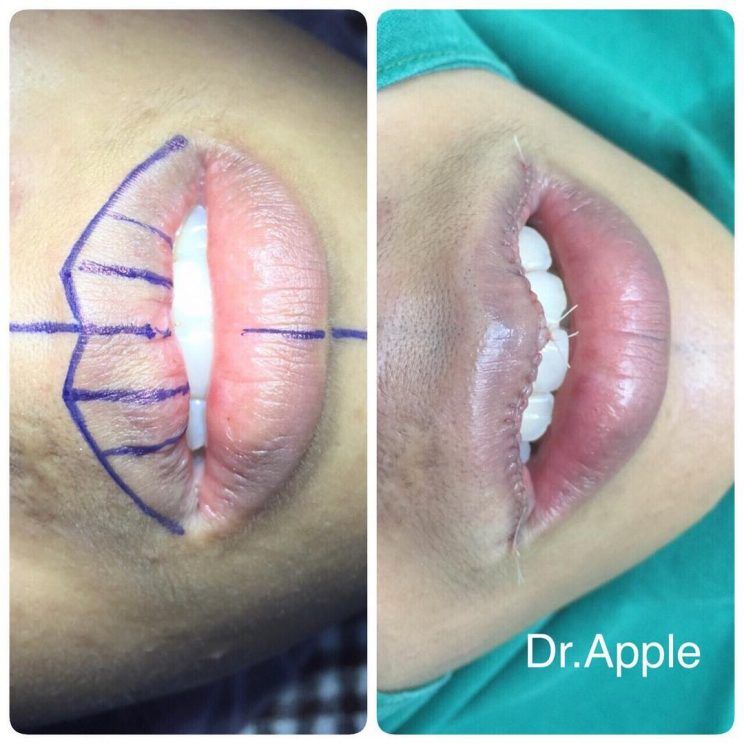 Redução de lábios é a nova tendência em cirurgia plástica