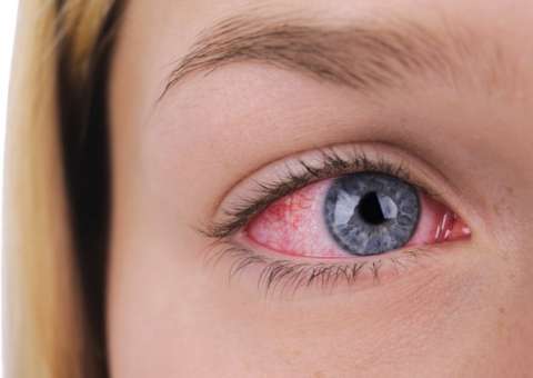 Você sabia que estresse favorece surgimento de herpes ocular?