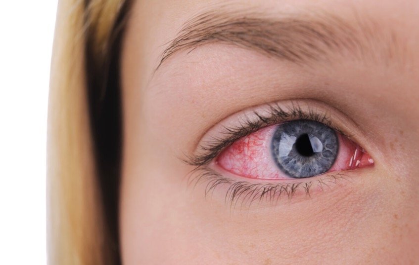 Você sabia que estresse favorece surgimento de herpes ocular?