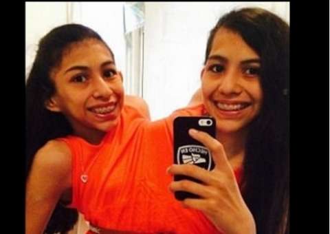 Gêmeas que nasceram unidas se recusam a se separar