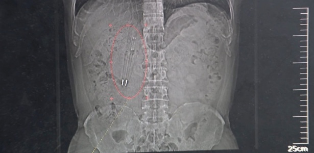 Homem passa quase 40 anos com dois objetos estranhos alojados no corpo