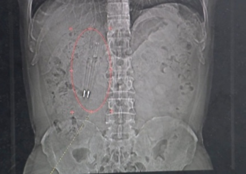 Homem passa quase 40 anos com dois objetos estranhos alojados no corpo