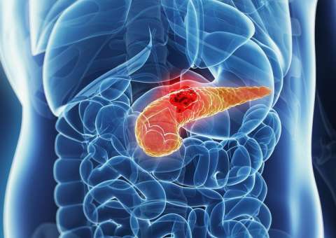 8 em cada 10 casos de câncer de pâncreas é descoberto em estado avançado