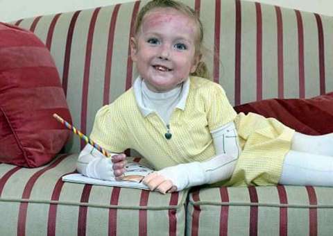 Menina sofre de doença que a impede de receber abraço