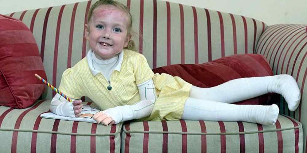 Menina sofre de doença que a impede de receber abraço