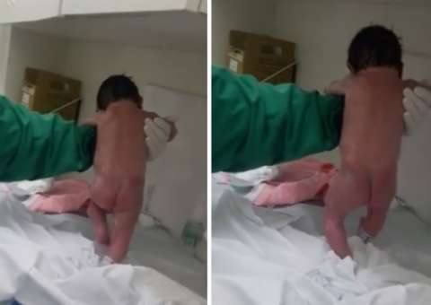  Pediatra explica ‘milagre’ que fez bebê andar logo após o parto
