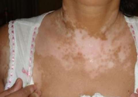 Em poucos dias a cura definitiva do vitiligo com apenas um ingrediente