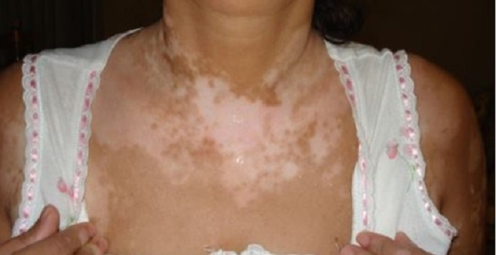 Em poucos dias a cura definitiva do vitiligo com apenas um ingrediente