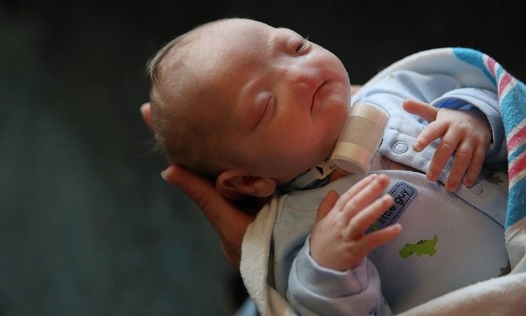 Bebê nasce com doença rara e detalhe no rosto intriga médicos