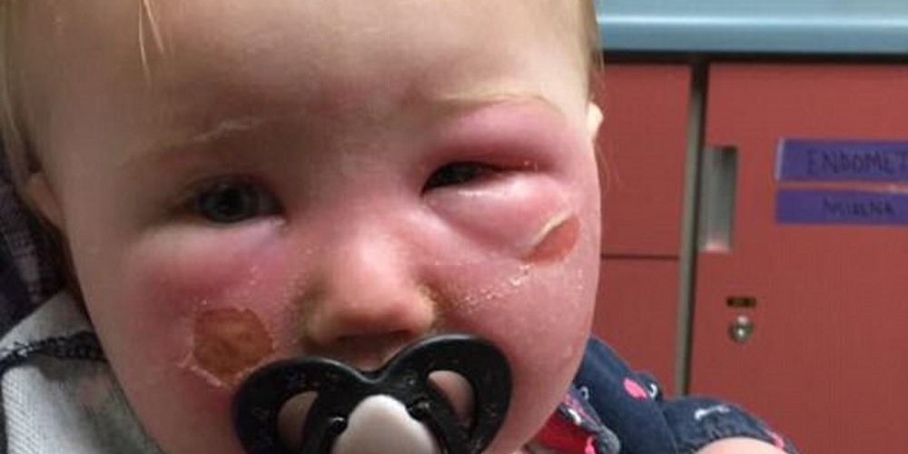 Protetor solar infantil causa queimaduras graves no rosto de bebê de um ano