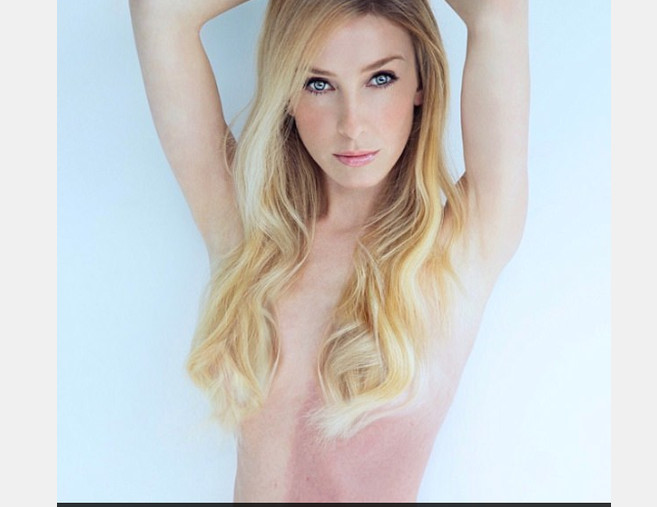 Mulher com 2 tons de pele descobre que irmã se fundiu a seu corpo na gestação