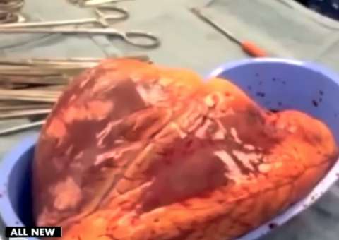 Coração bate fora do corpo humano por 25 minutos e vídeo surpreende  