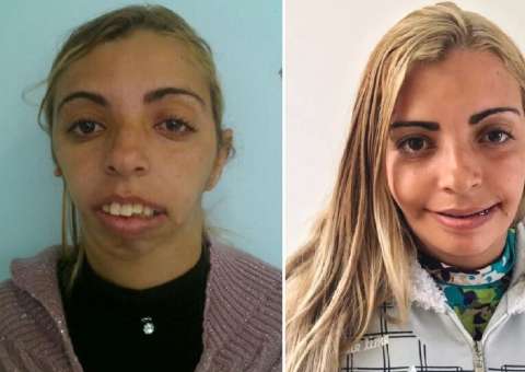 Mulher chamada de 'monstro' por ter síndrome recebe doações e fica 'irreconhecível'