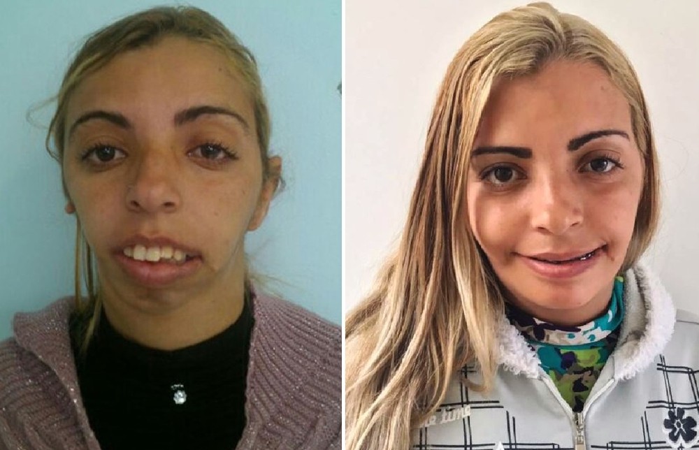 Mulher chamada de 'monstro' por ter síndrome recebe doações e fica 'irreconhecível'