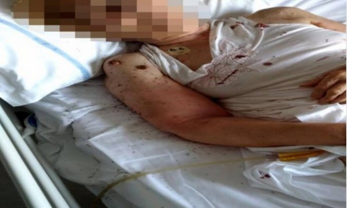 Imagem de mulher coberta por formigas em leito de hospital revolta internautas  