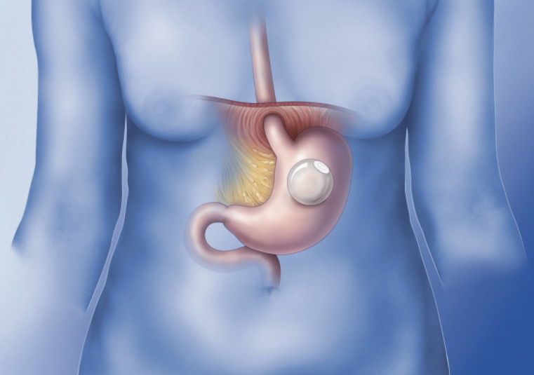 Nova técnica de redução de estômago por endoscopia é testada no Brasil
