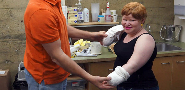 Mulher é perseguida e tem mãos cortadas pelo vizinho por ser albina 