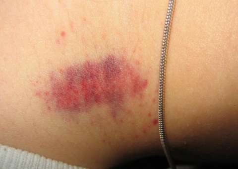 Jovem morre aos 17 anos após levar “chupão” no pescoço da namorada