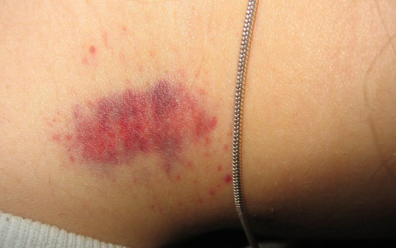 Jovem morre aos 17 anos após levar “chupão” no pescoço da namorada