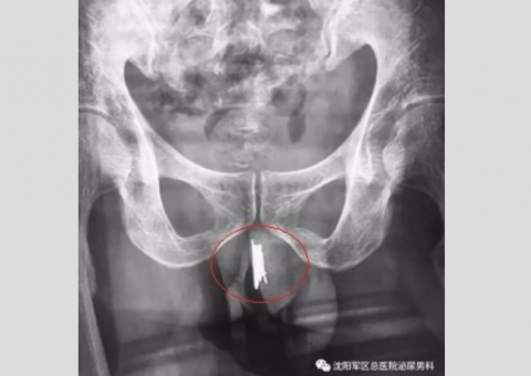 Para sentir prazer, homem enfia 15 agulhas no pênis e o pior acontece