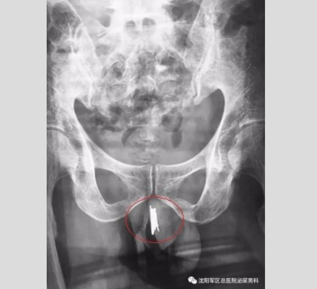 Para sentir prazer, homem enfia 15 agulhas no pênis e o pior acontece