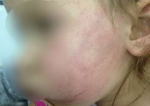 Madrasta confessa ter agredido enteada de 2 anos por ciúmes do marido