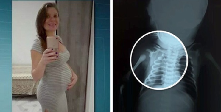 Bebê baleado quando estava no útero pode ter salvo vida da mãe