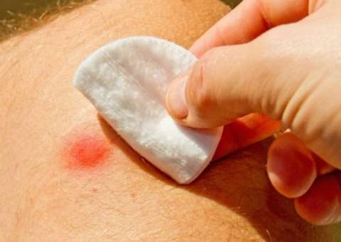 Remédios caseiros podem amenizar a dor e curar furúnculos. Veja receitas 