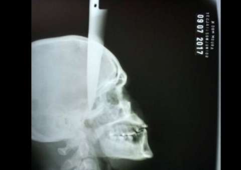 Após discussão em bar, homem fica com faca cravada na cabeça 