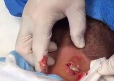 Médicos retiram enorme cisto do pescoço de paciente e choca a todos