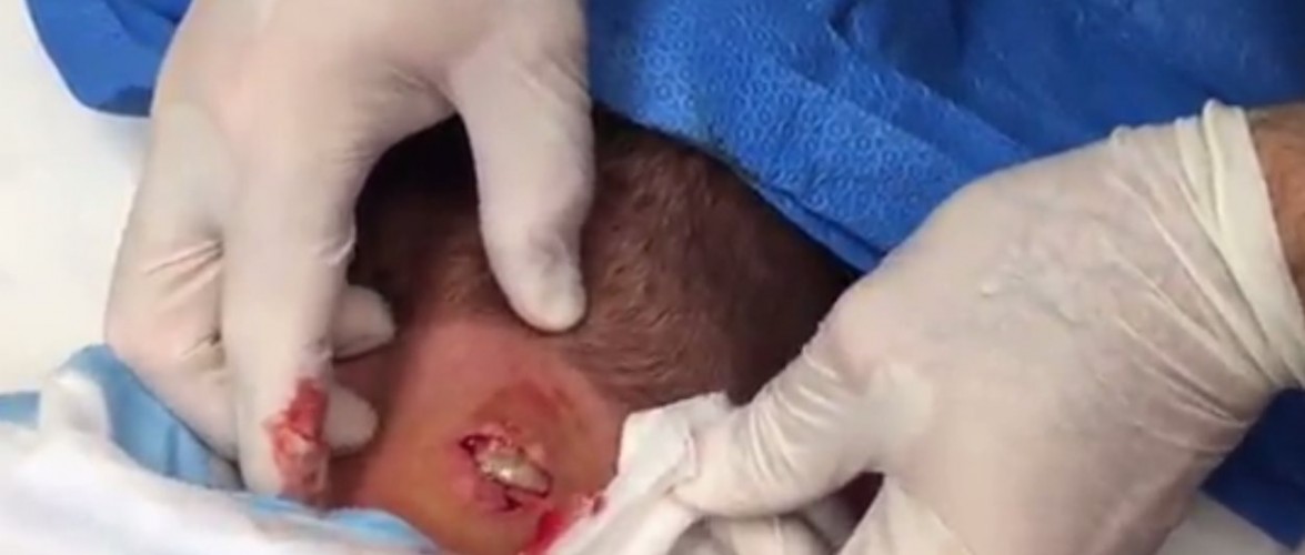 Médicos retiram enorme cisto do pescoço de paciente e choca a todos