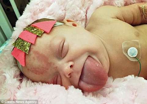 Bebê quase morre sufocado com a própria língua passa por cirurgia