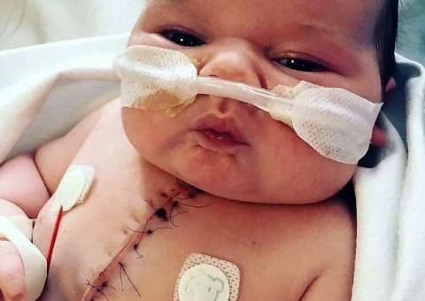 Bebê que nasceu com metade do coração surpreende médicos após cirurgia