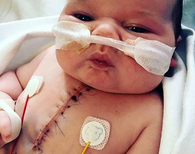 Bebê que nasceu com metade do coração surpreende médicos após cirurgia