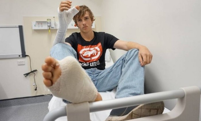 Jovem com polegar da mão decepado teve que passar por cirurgia inusitada