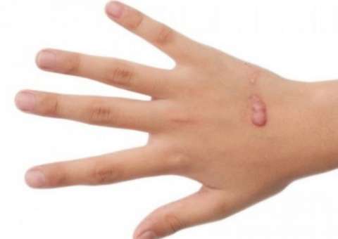 Conheça dois tratamentos naturais eficazes contra queloide 