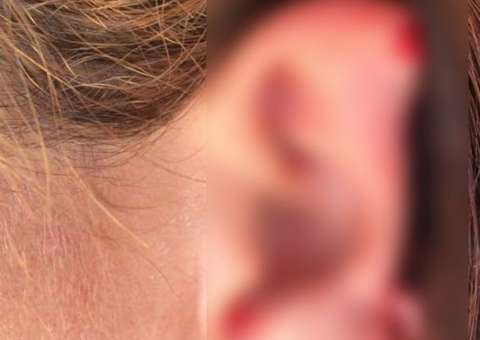  Esposa furiosa arranca orelha de suposta amante a dentadas