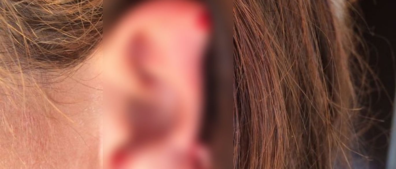  Esposa furiosa arranca orelha de suposta amante a dentadas