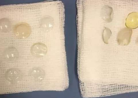 Médicos encontram 27 lentes de contato em olho de paciente 