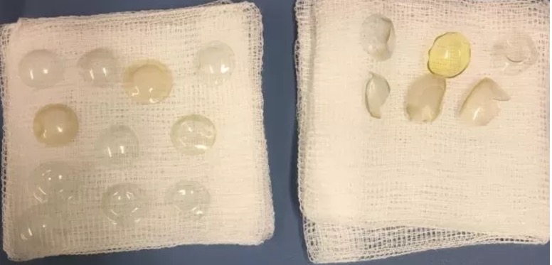 Médicos encontram 27 lentes de contato em olho de paciente 