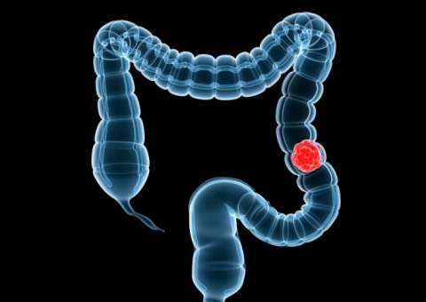 Saiba como  prevenir pólipos intestinais e o câncer 