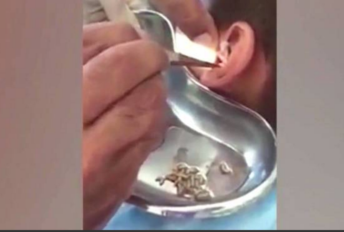 Criança reclama com fortes dores no ouvido e médicos ficam chocados