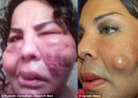 Mulher transexual injeta cimento no rosto e implora ajuda médica para lidar com consequências