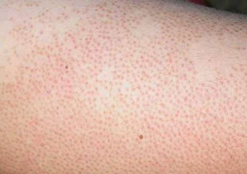 O que são essas manchas ou “bolinhas” vermelhas que aparecem na sua pele?