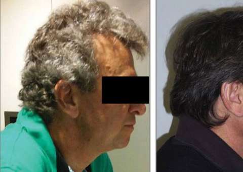 Tratamento para câncer que devolveu cor aos cabelos dos pacientes grisalhos