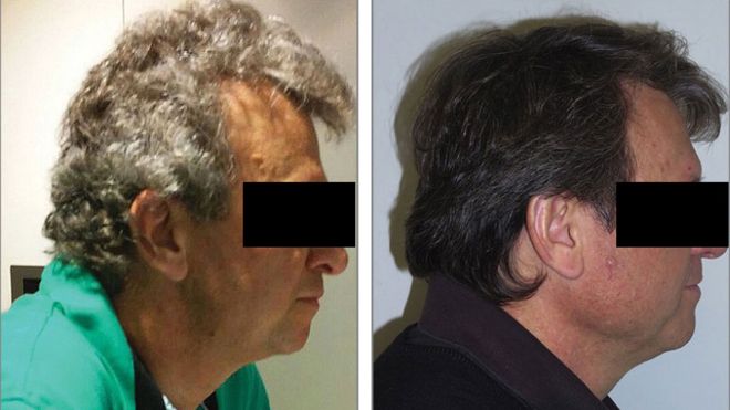 Tratamento para câncer que devolveu cor aos cabelos dos pacientes grisalhos